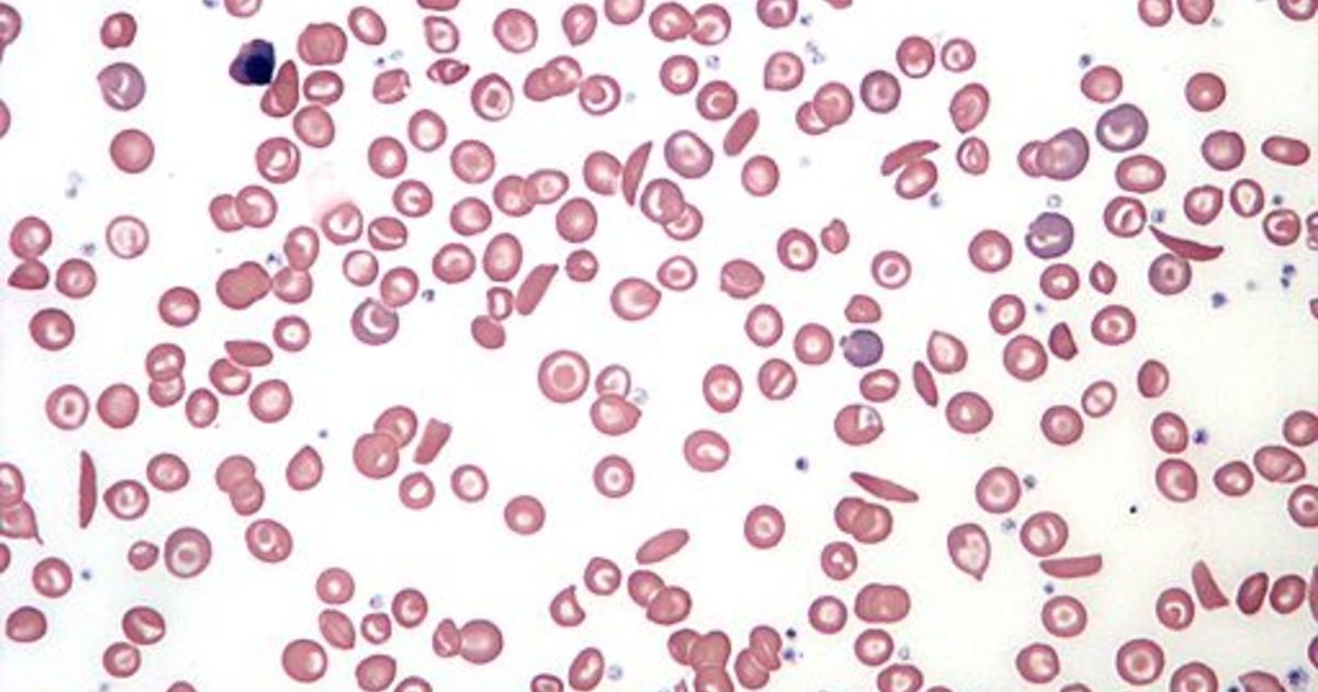 Sickle Cell Origins Unraveled From Contemporary Genome Sequences ...