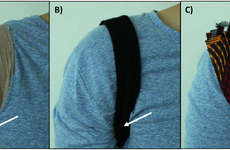 Researchers tested three methods - a bandage, an elastic sweatband, and a strip of cotton fabric - for securing tubes (whose position is noted with arrows) in the axilla.