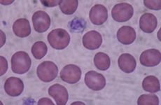 Giant platelets on a blood smear