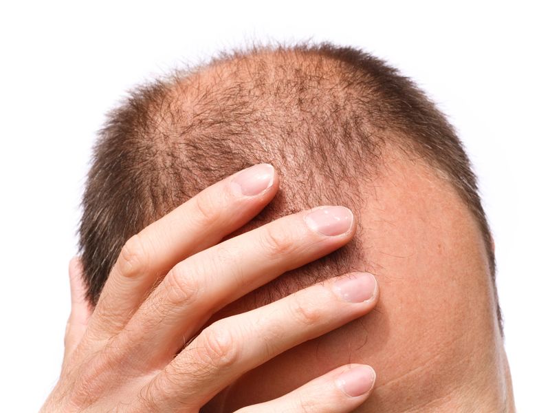 Male Pattern Baldness Study Uncovers Potential Genetic Predictors Genomeweb