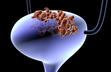 bladder cancer.jpg