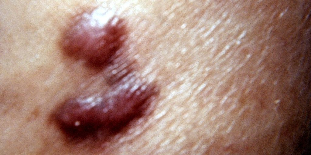 Researchers Validate Rapid Molecular Kaposi's Sarcoma Assay in Uganda - Vimarsana News