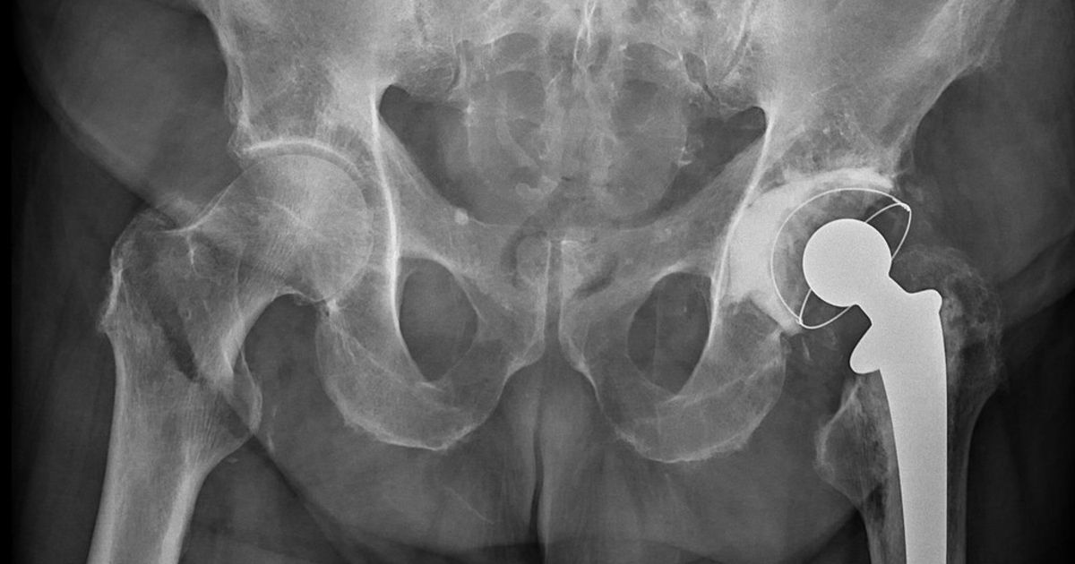 Hip Fracture Risk Linked to Blood Plasma Protein Score | GenomeWeb