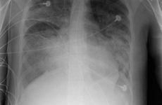 Chest X-Ray ARDS