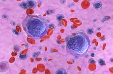 Acute myeloid leukemia