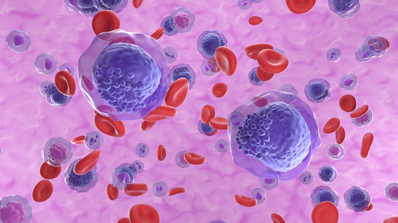 Acute myeloid leukemia